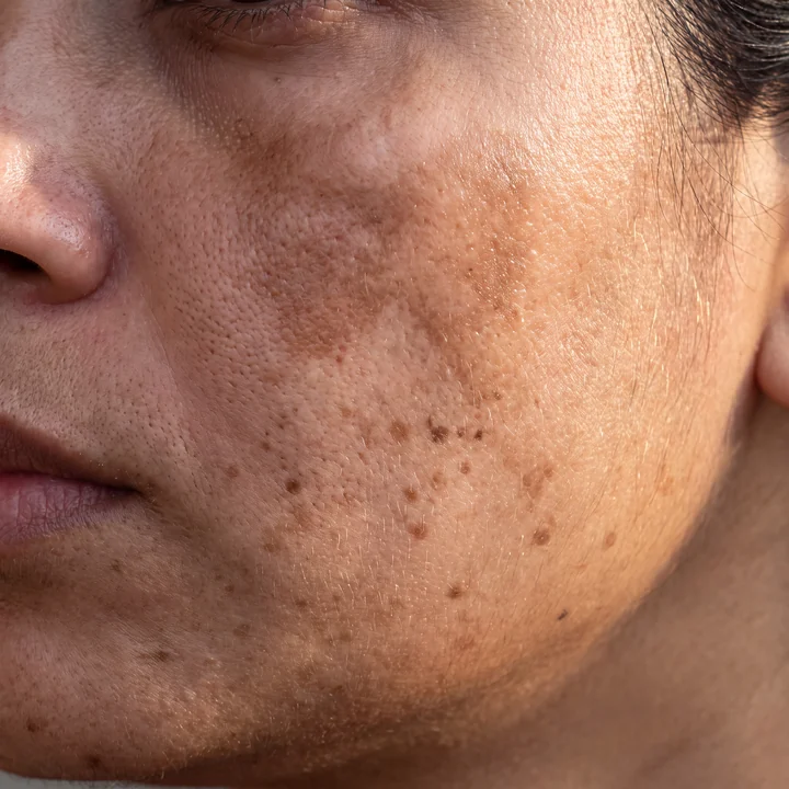 Close-up of skin with dark spots and pigmentation